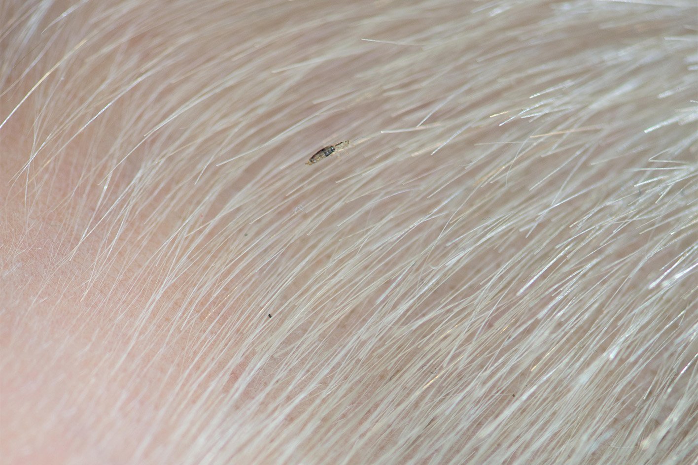 scalp when have lice